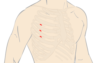 ダビンチ キーホール手術