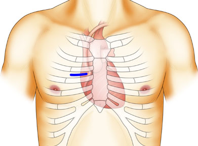 大動脈弁置換術（小切開）