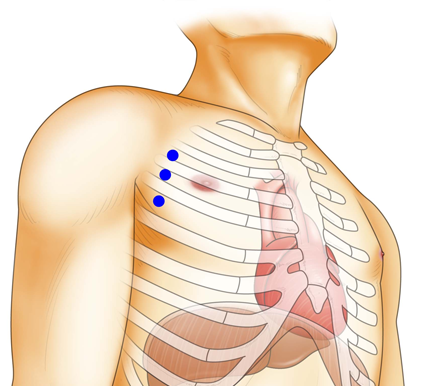 キーホール手術の画期的低侵襲性（※）